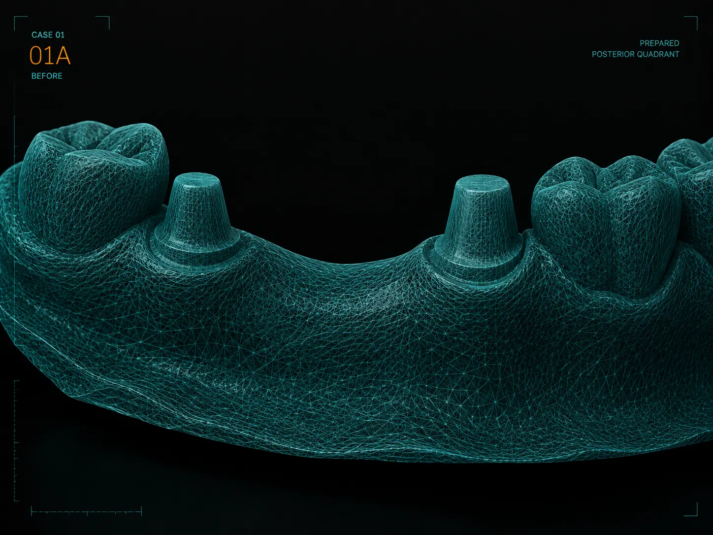Intake scan of a prepared posterior quadrant for a three-unit bridge